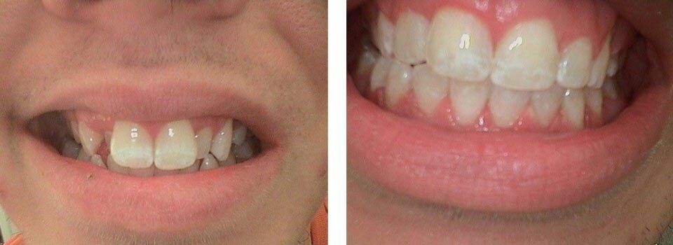 Before and After of teeth Treatment — Dentistry in Terre Haute, IN