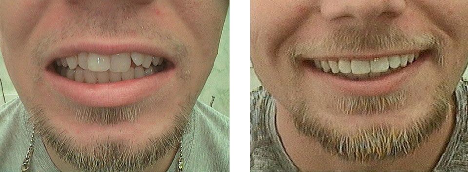 Man showing his teeth after treatment — Dentistry in Terre Haute, IN