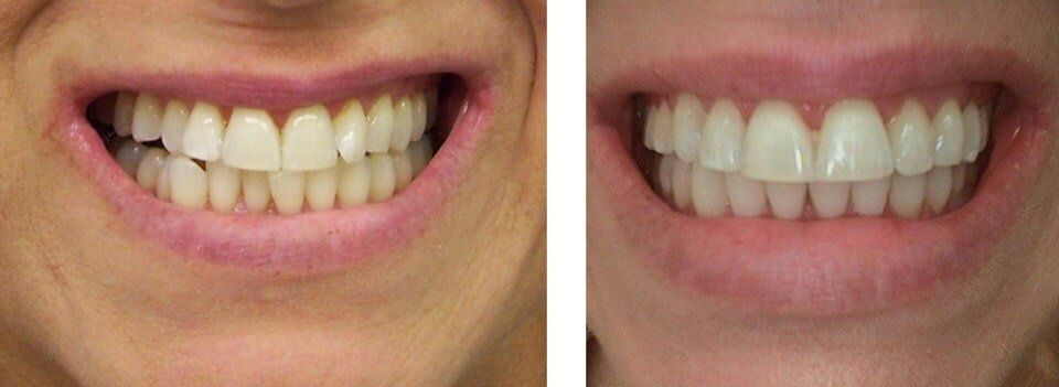 Teeth after Orthodontics Treatment — Dentistry in Terre Haute, IN