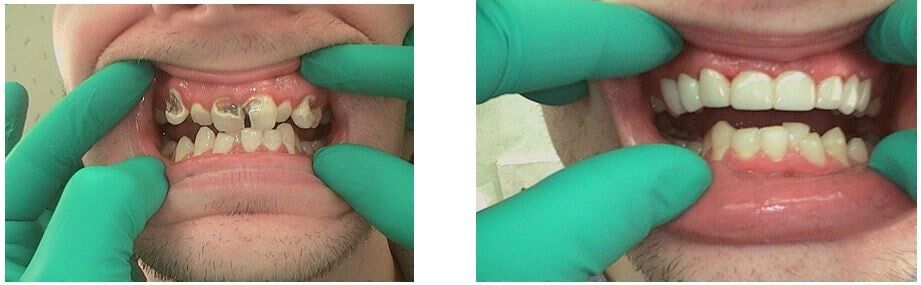 Teeth Orthodontic Treatment Result — Dentistry in Terre Haute, IN