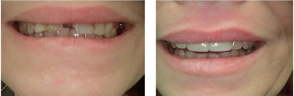 Dent Treatment — Dentistry in Terre Haute, IN