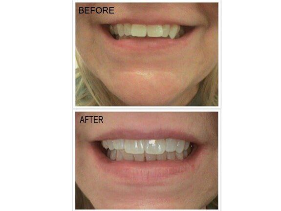 Before and After Orthodontic Treatment - Orthodontics in Terre Haute, IN