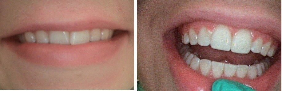 White Teeth — Orthodontics in Terre Haute, IN