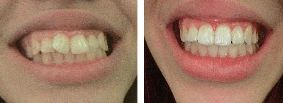Uneven Teeth Before and After Correction - Orthodontics in Terre Haute, IN