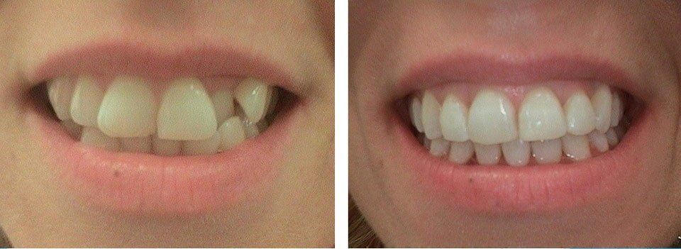 Abnormal Tooth Grown Before and After Orthodontics Treatment - Orthodontics in Terre Haute, IN