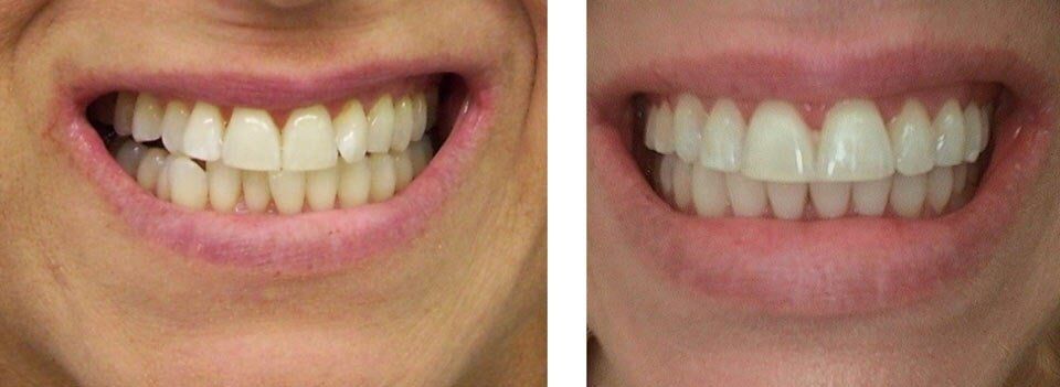 A teeth with irregularity done with Orthodontics Treatment — Orthodontics in Terre Haute, IN