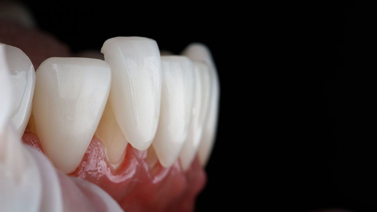 veneers vs invisalign