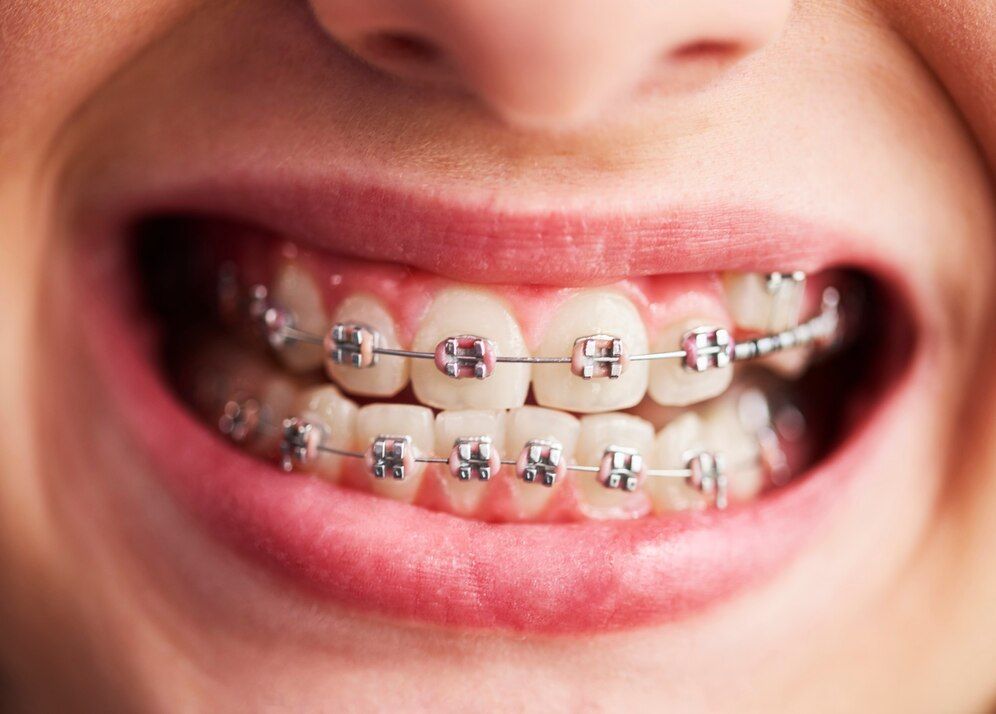 Braces