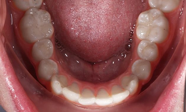 Open mouth showing lower teeth and tongue, with noticeable white spots on the gums and lower teeth.