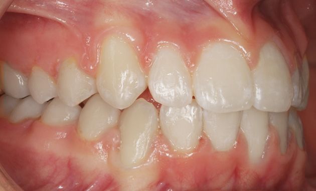 Close-up of teeth with an overbite and crowded front incisors