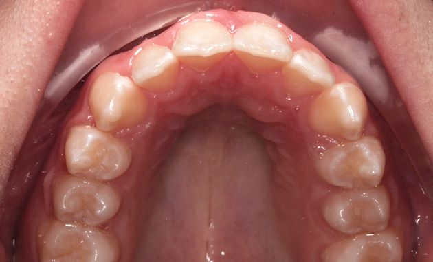 Open mouth showing upper dental arch and palate, with teeth visible from the inside.