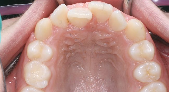 Upper dental arch and palate shown with the mouth open, teeth visible from above.