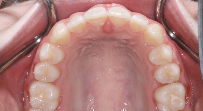 Upper view of a mouth showing the upper teeth and pink palate with dental retractors visible