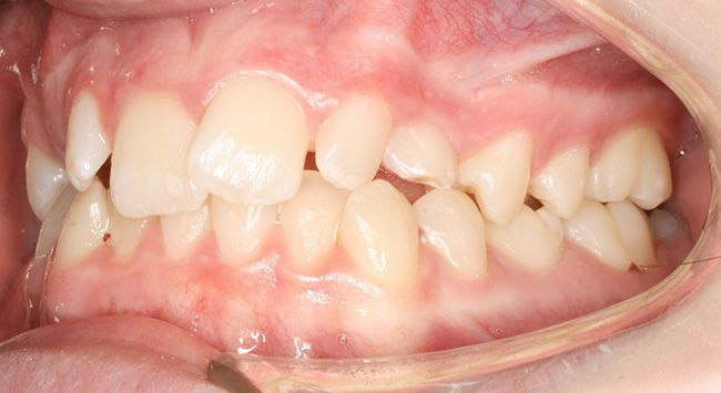 Close-up of teeth with dental retractor, showing crowded upper and lower teeth and gums