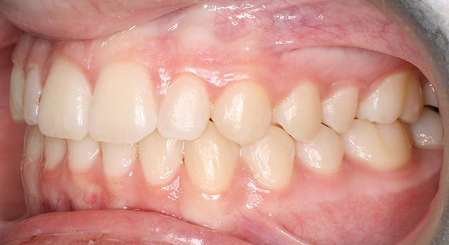 Close-up of a mouth showing teeth with visible crowding and misalignment