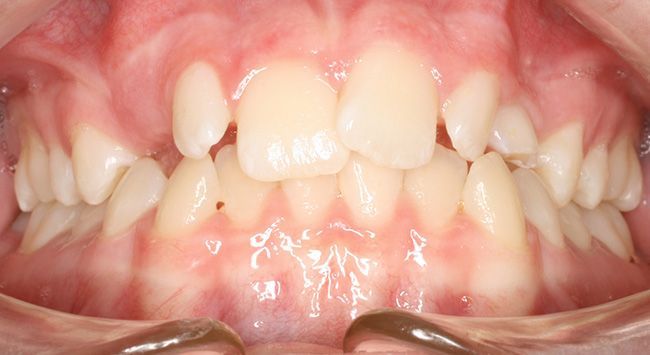 Front view of teeth and gums, showing crowded upper front teeth and a visible overbite