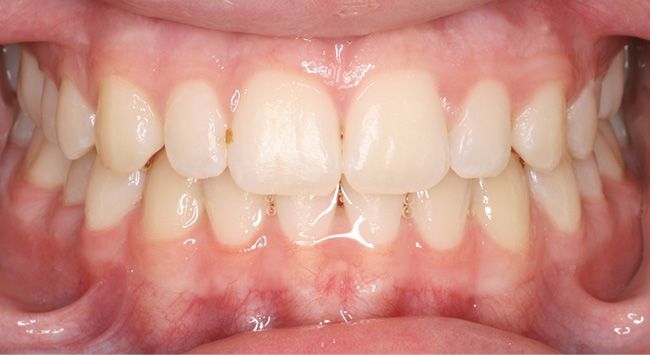 Close-up of teeth and gums with a centered upper tooth gap and slight misalignment