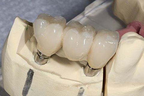 Dental Implants — Dental Services in Victorville, CA
