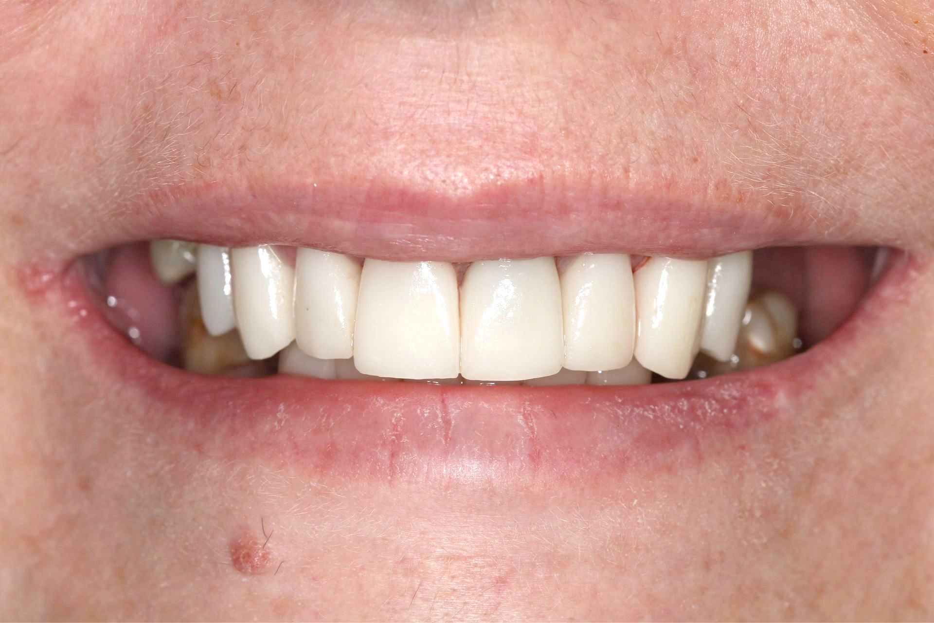 A close up of a person 's mouth with white teeth.