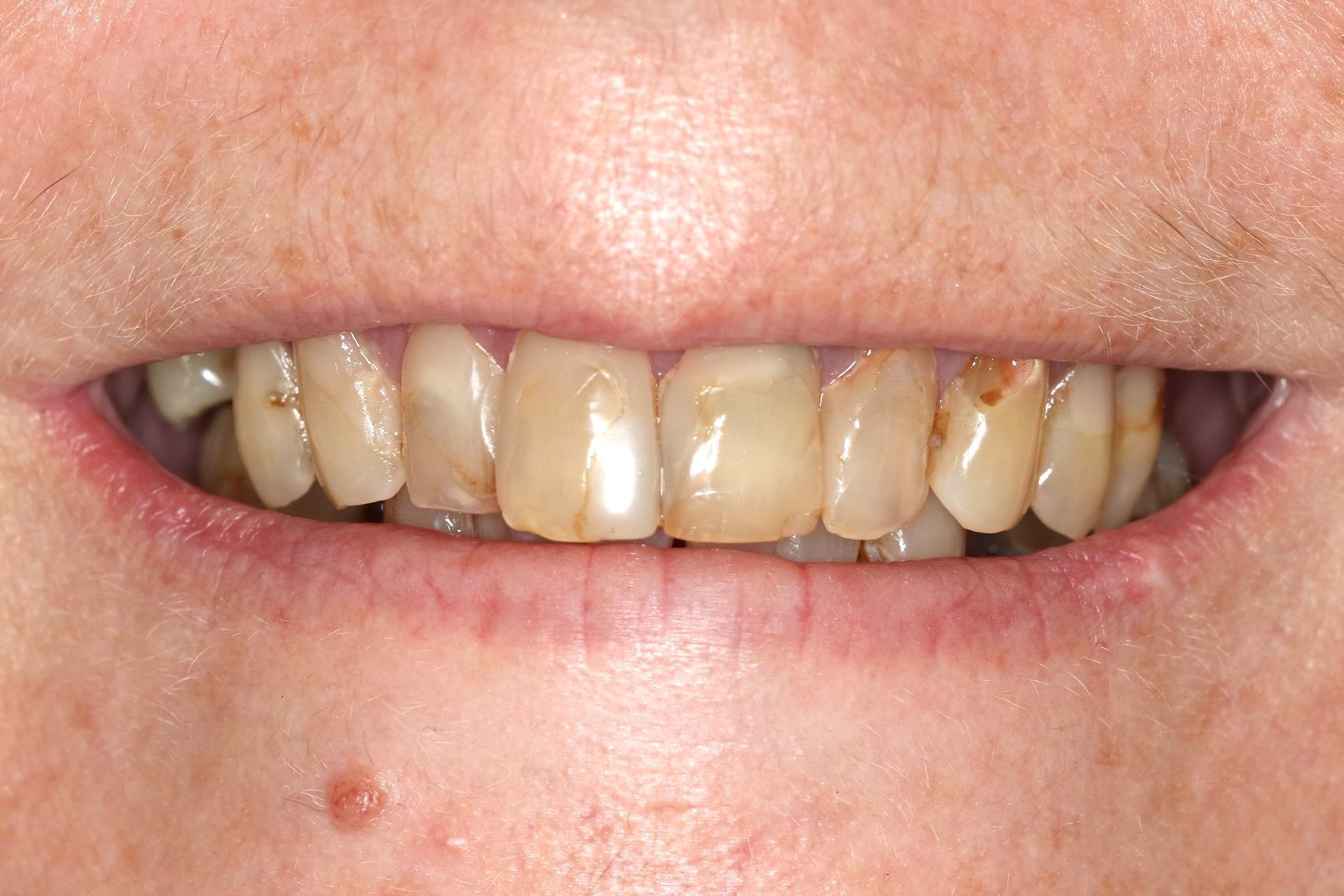 A close up of a person 's teeth with a lot of stains on them.