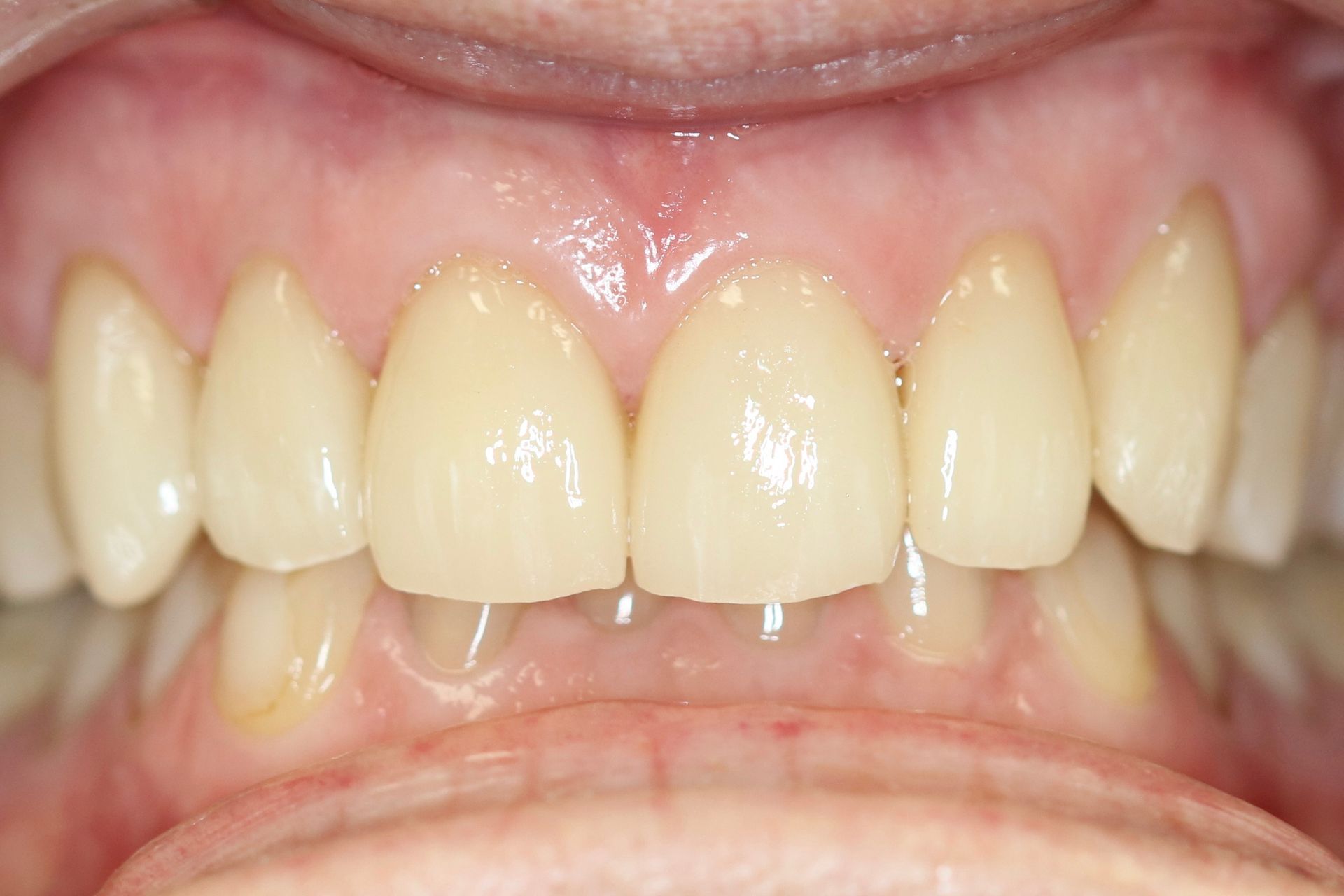 A close up of a person 's mouth with white teeth.