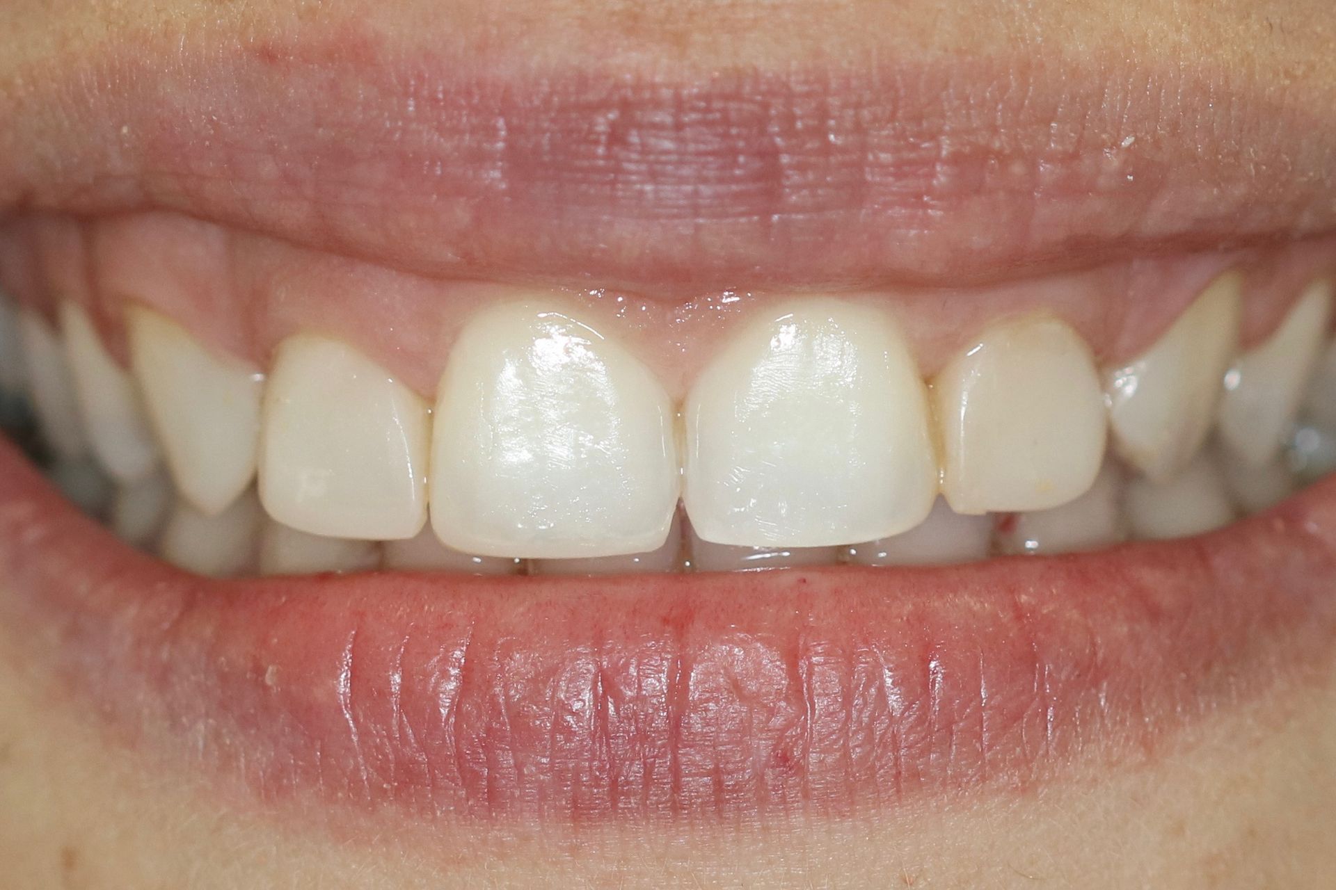 A close up of a person 's mouth with white teeth.