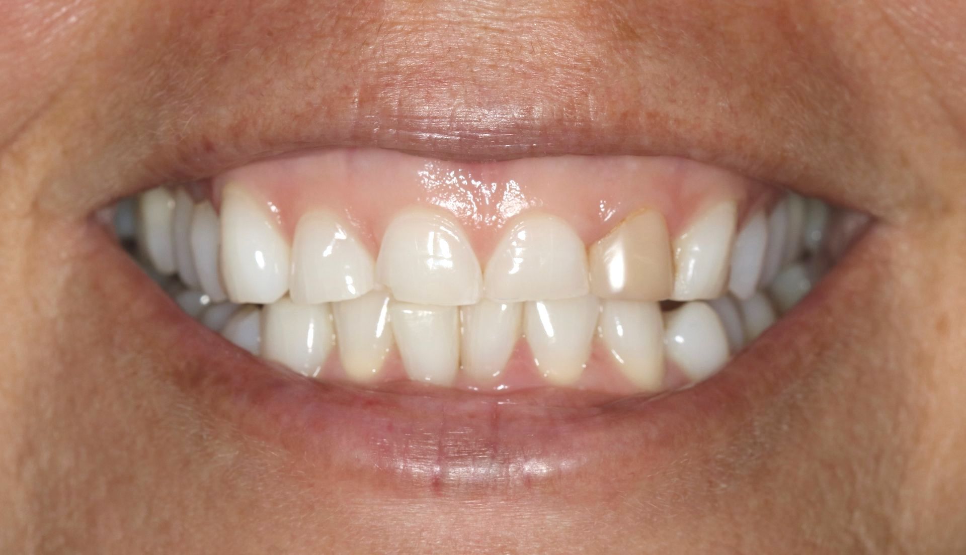 A close up of a person 's teeth with a lot of stains on them.