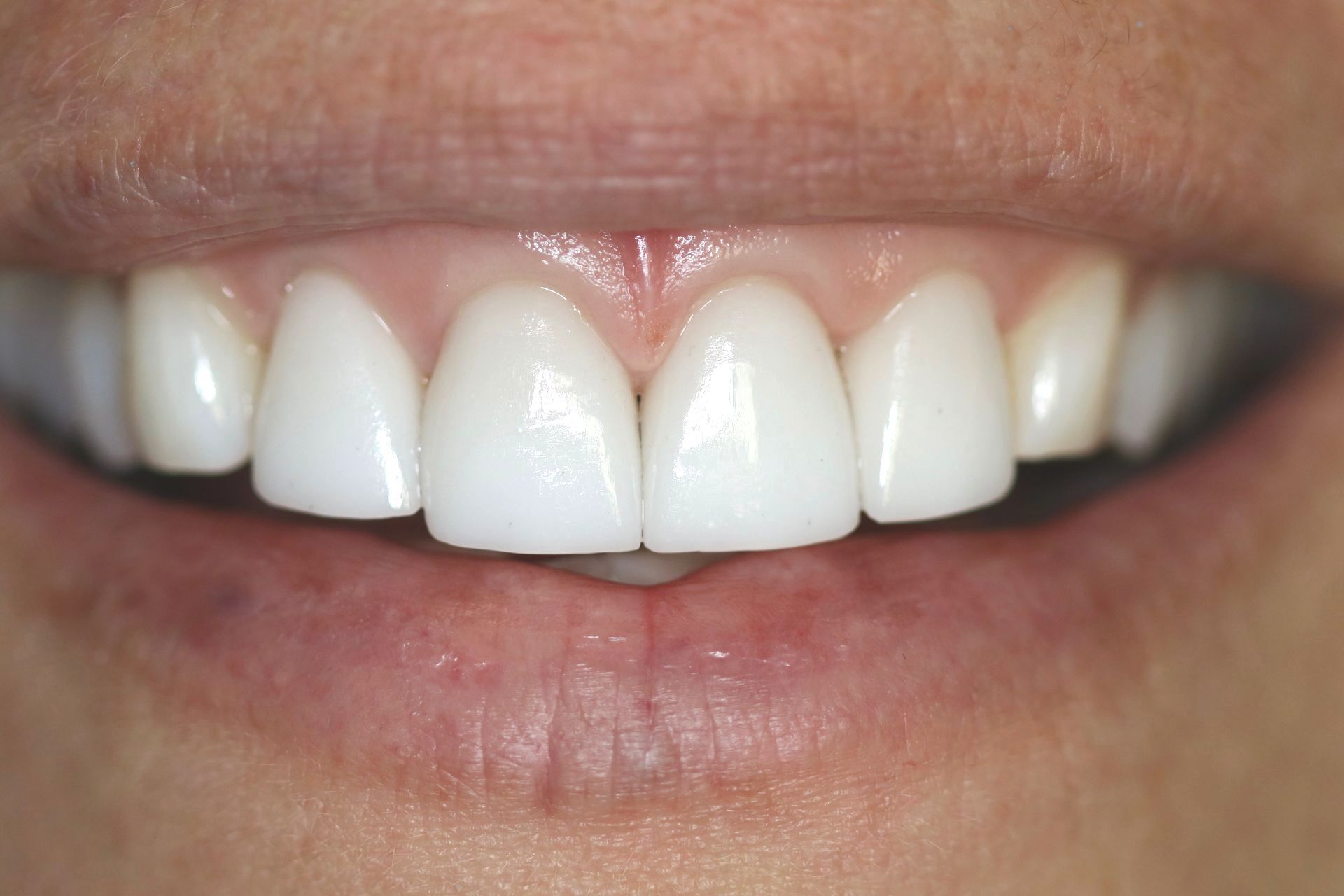 A close up of a person 's mouth with white teeth.