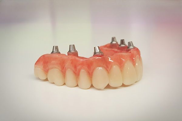 A model of a dental implant with a broken tooth next to it.