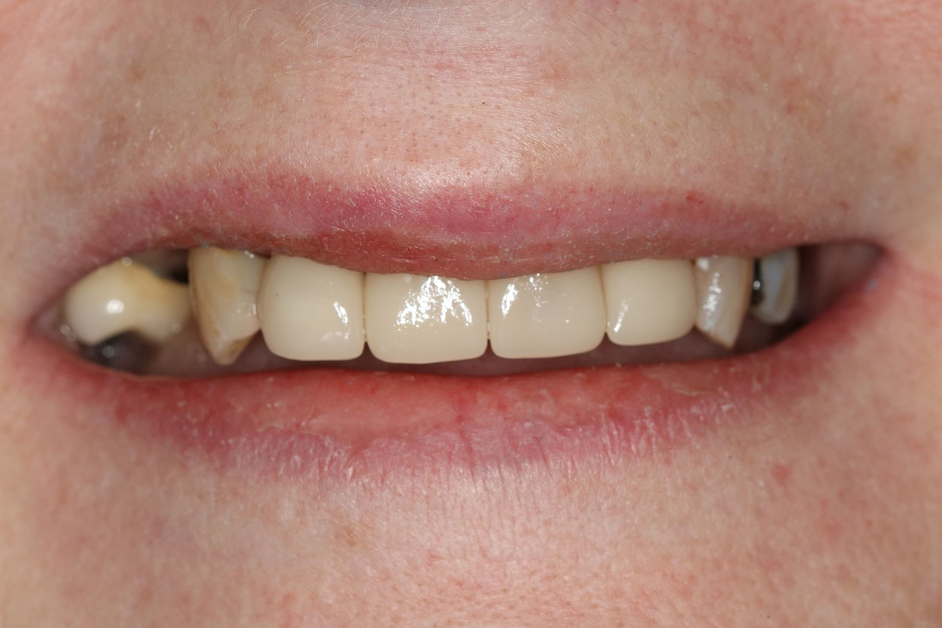 A close up of a person 's mouth with white teeth.