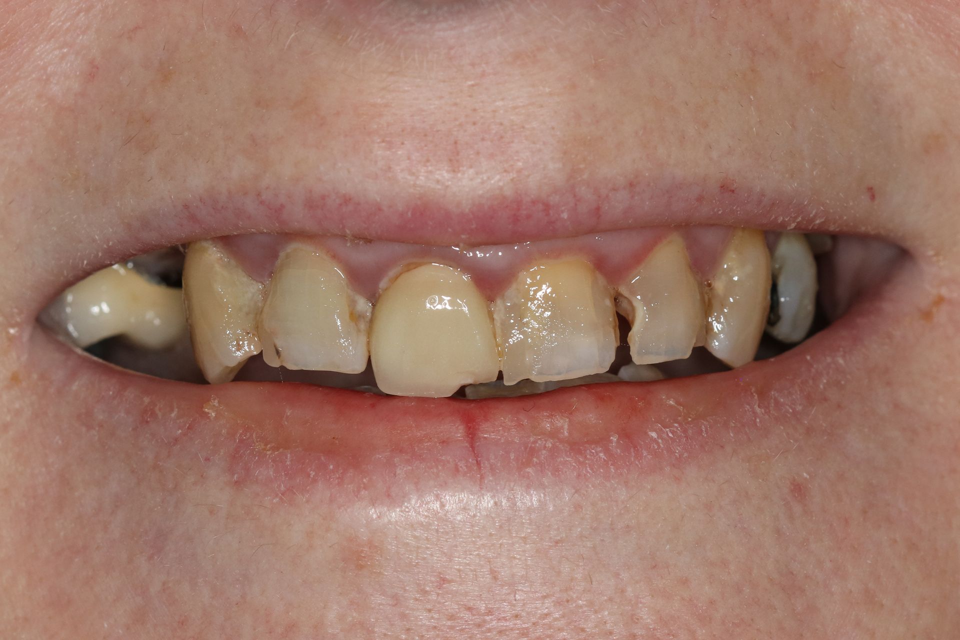 A close up of a person 's teeth with a lot of stains on them.
