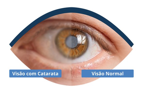 Um close do olho de uma pessoa com catarata e um olho normal.