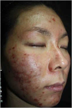 A woman with acne on her face has her eyes closed