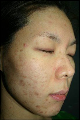 A woman with acne on her face has her eyes closed