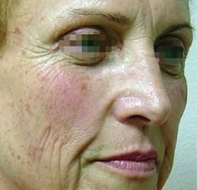 Before Collagen Induction