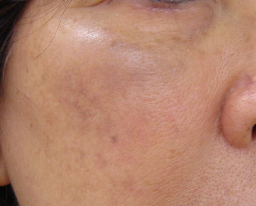 After Collagen Induction