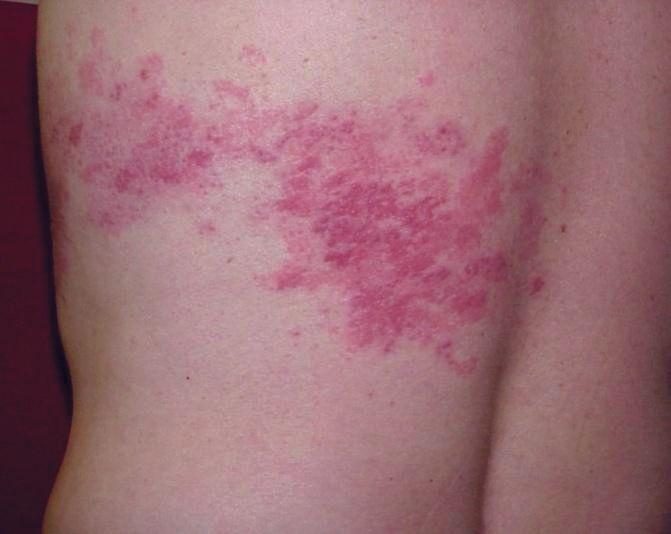 A close up of a person 's back with a rash on it.