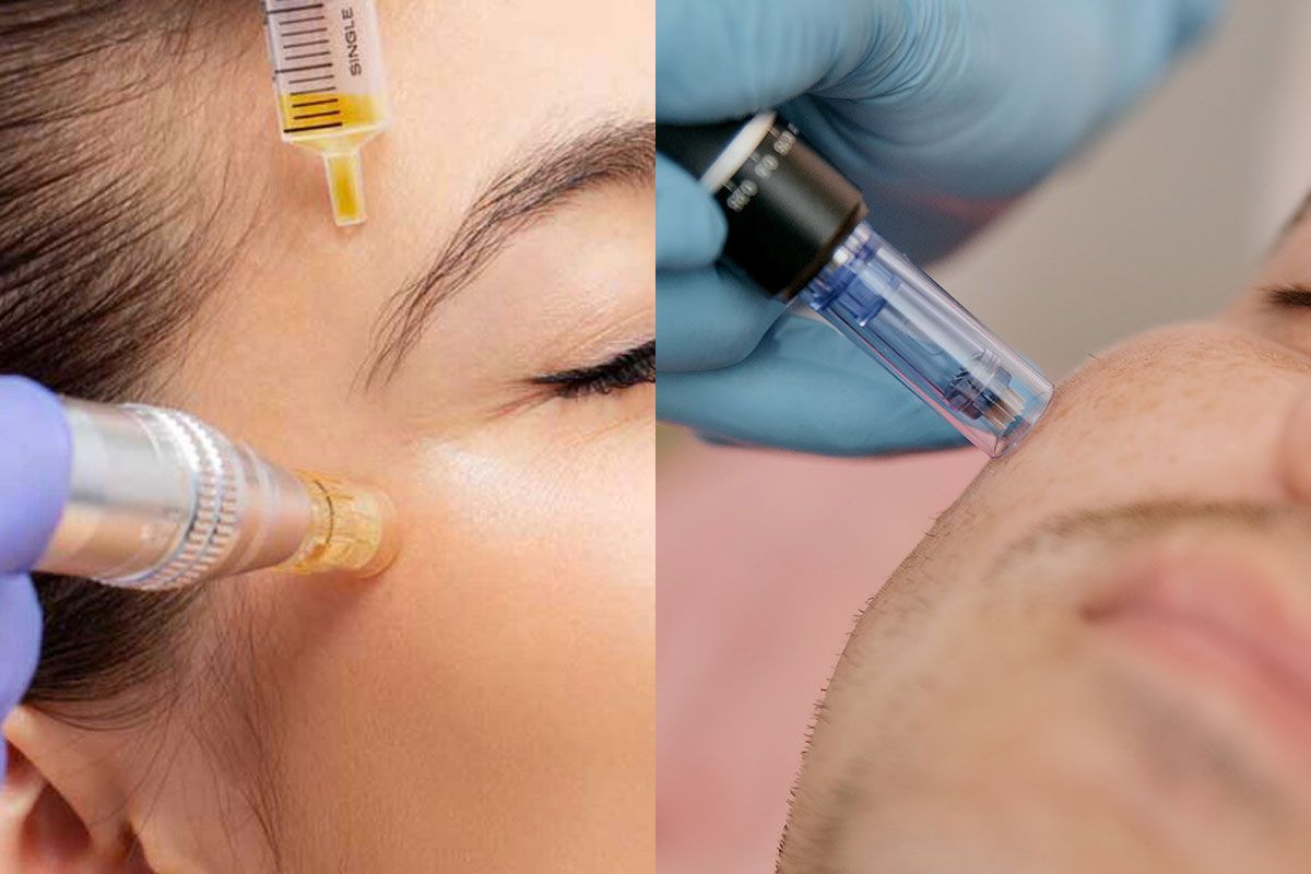PRP nano needling photo