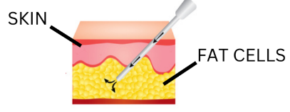 Sameglutide picture