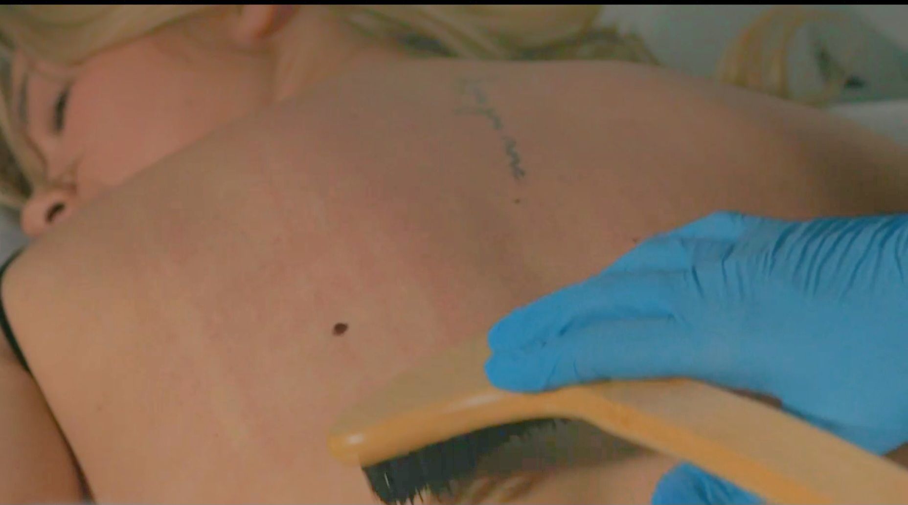 A person's back being treated with a brush, blue-gloved hand, tattoo visible.