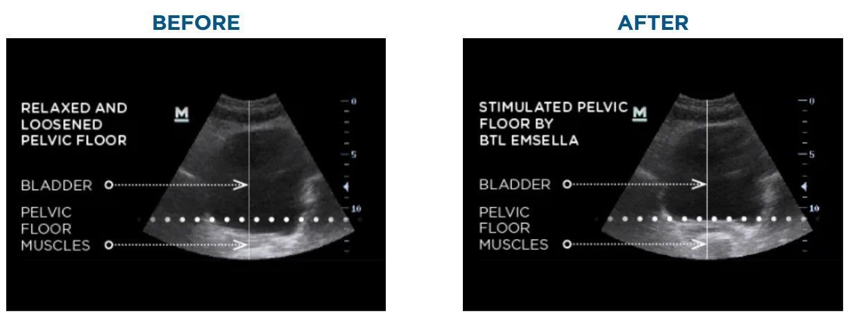 A before and after picture of an ultrasound of a bladder