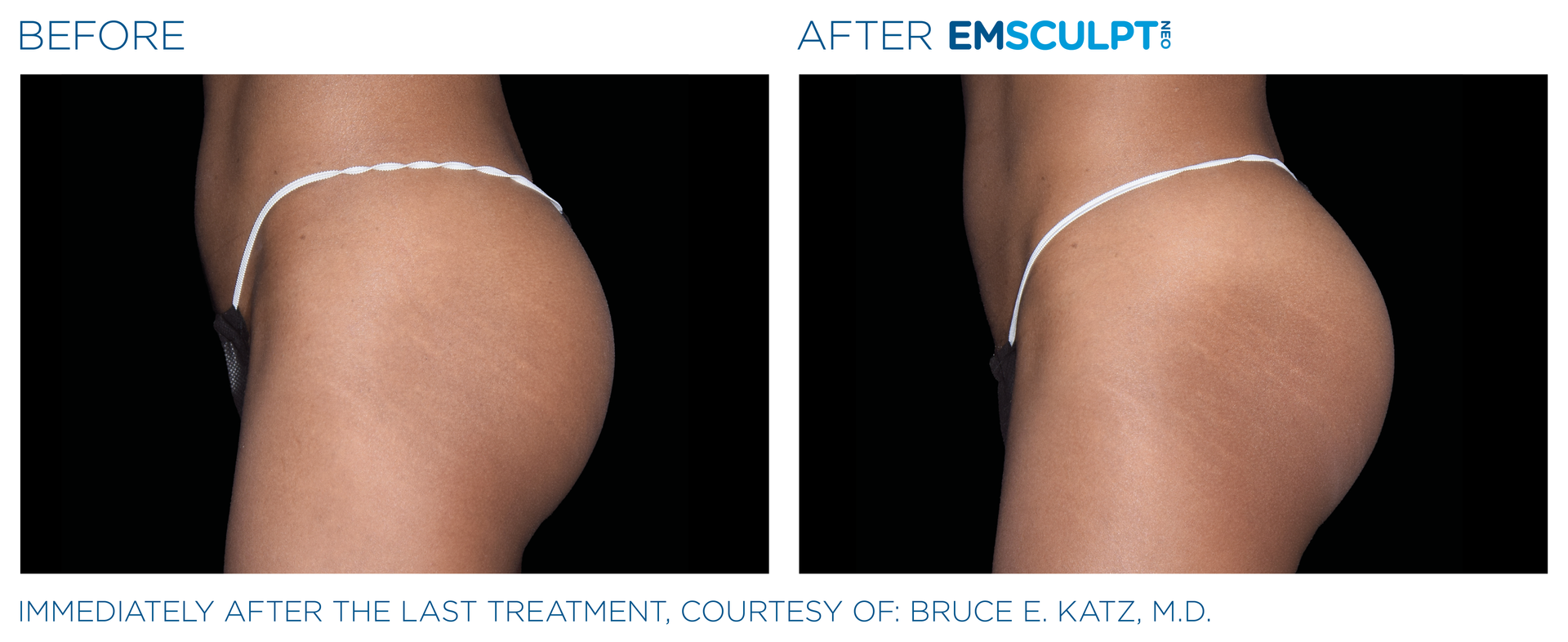 Immediately after last treatment of woman's buttocks