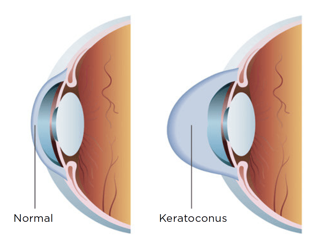 side view of the eye showing what keratoconus is