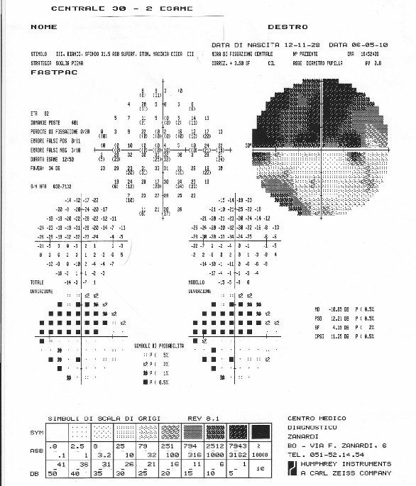 Analisi pressione oculare 2