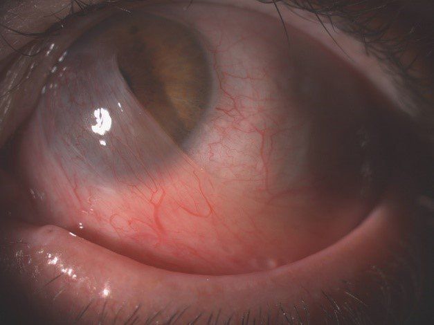 Misurazione pressione oculare