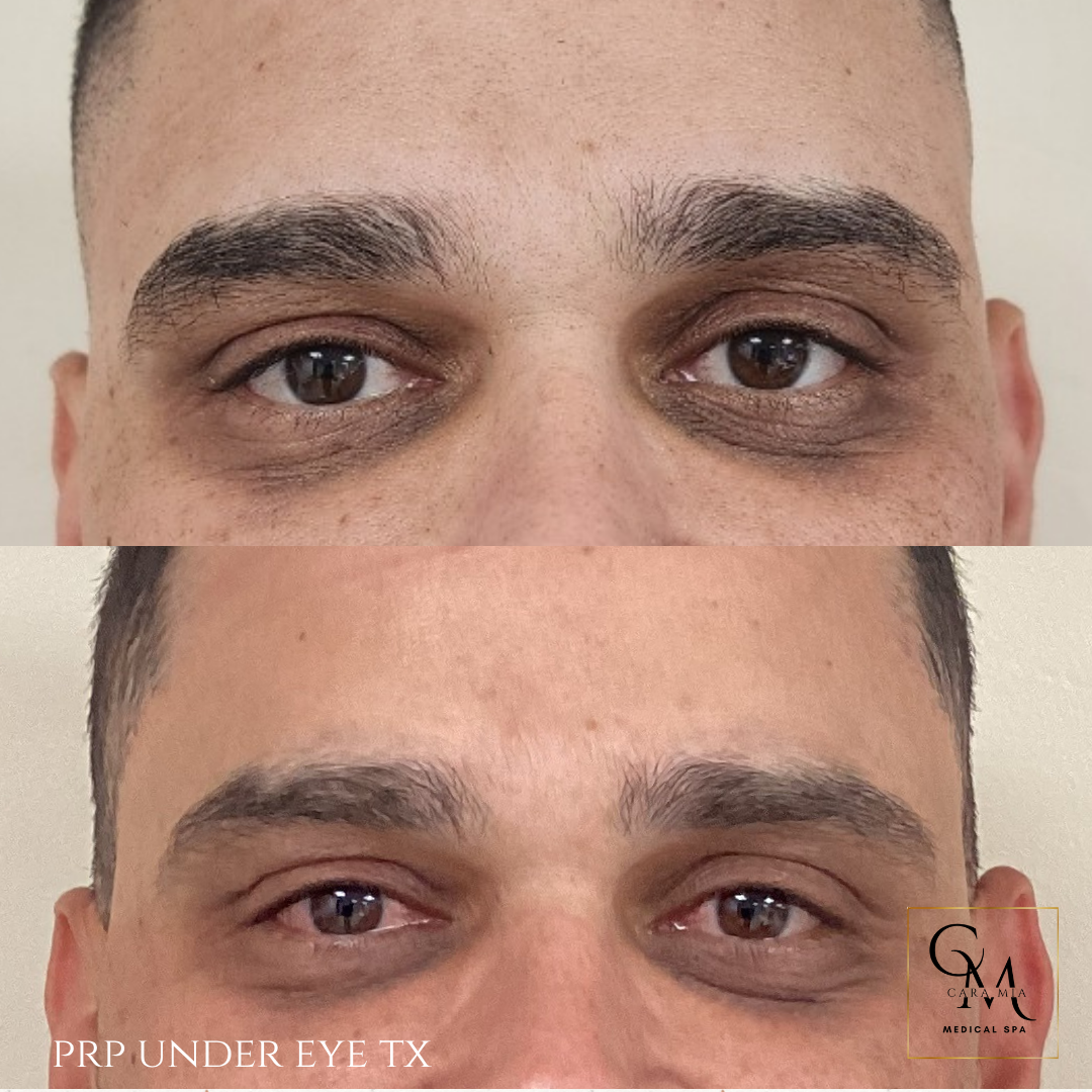 Side-by-side comparison of a person's eyes before and after a PRP under-eye treatment, showing reduced dark circles.