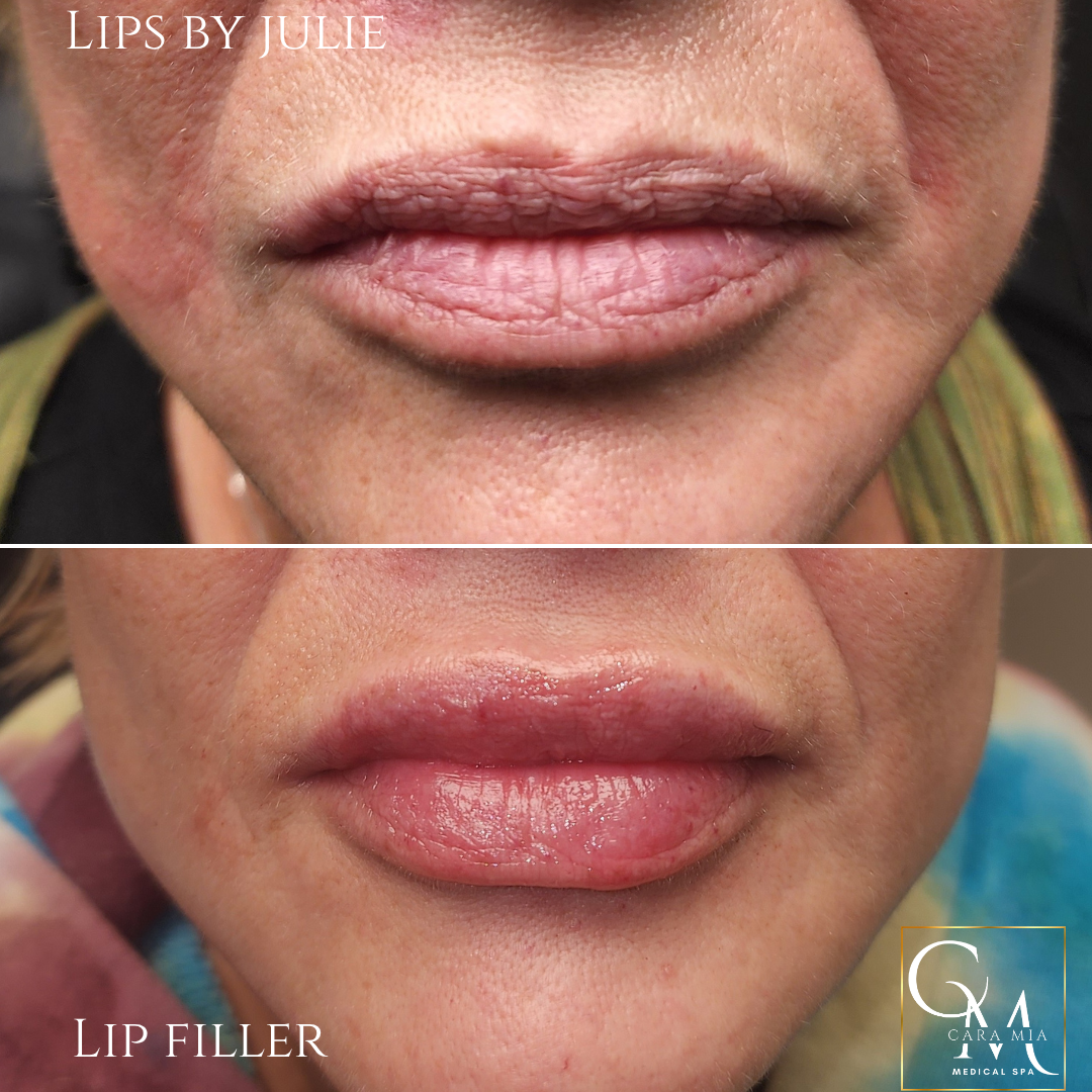 Before and after of a person's lip filler. Upper lip has wrinkles, lower is fuller and smooth.