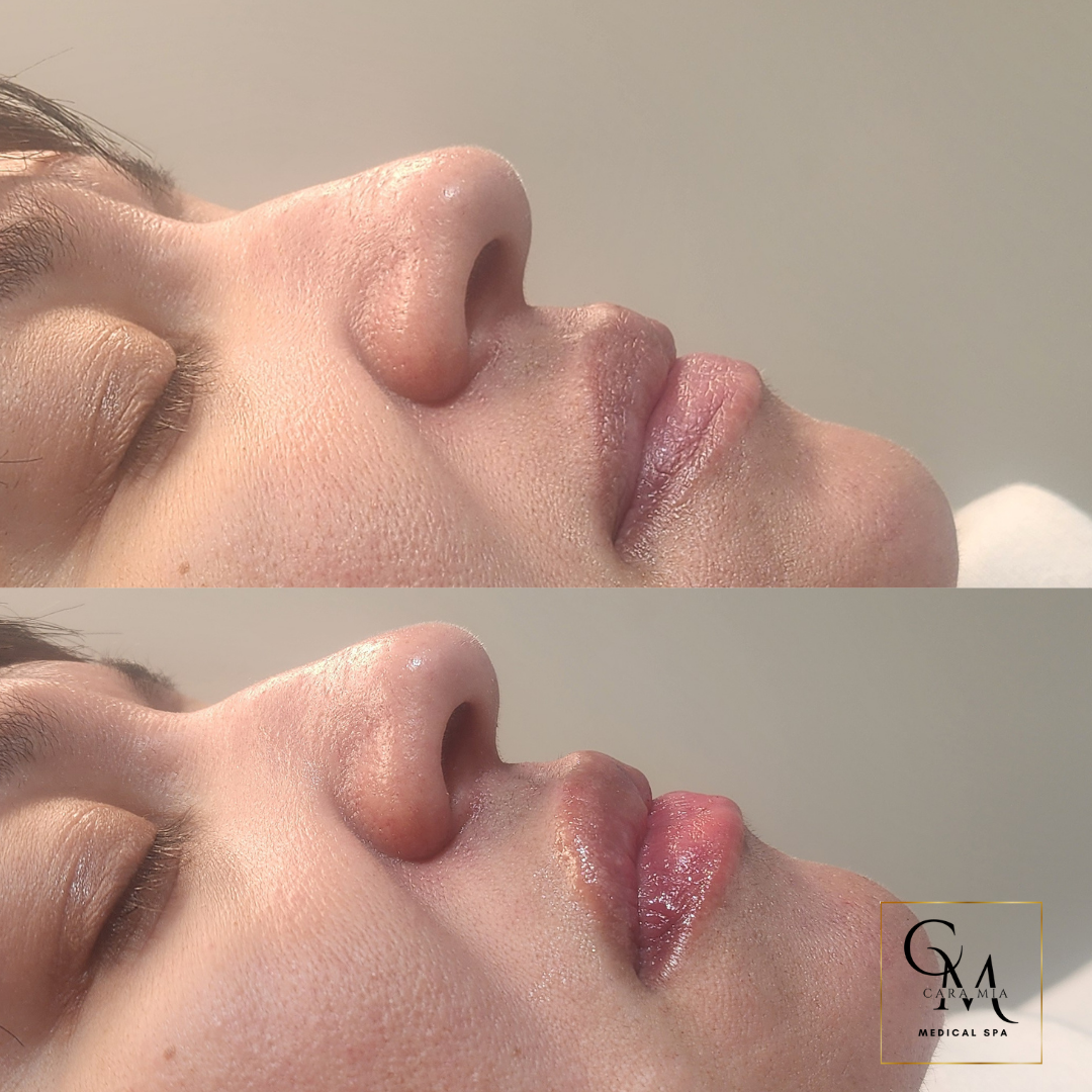 Two side-by-side images of lips. Bottom image has fuller lips than the top image. Both have a nose and closed eye.