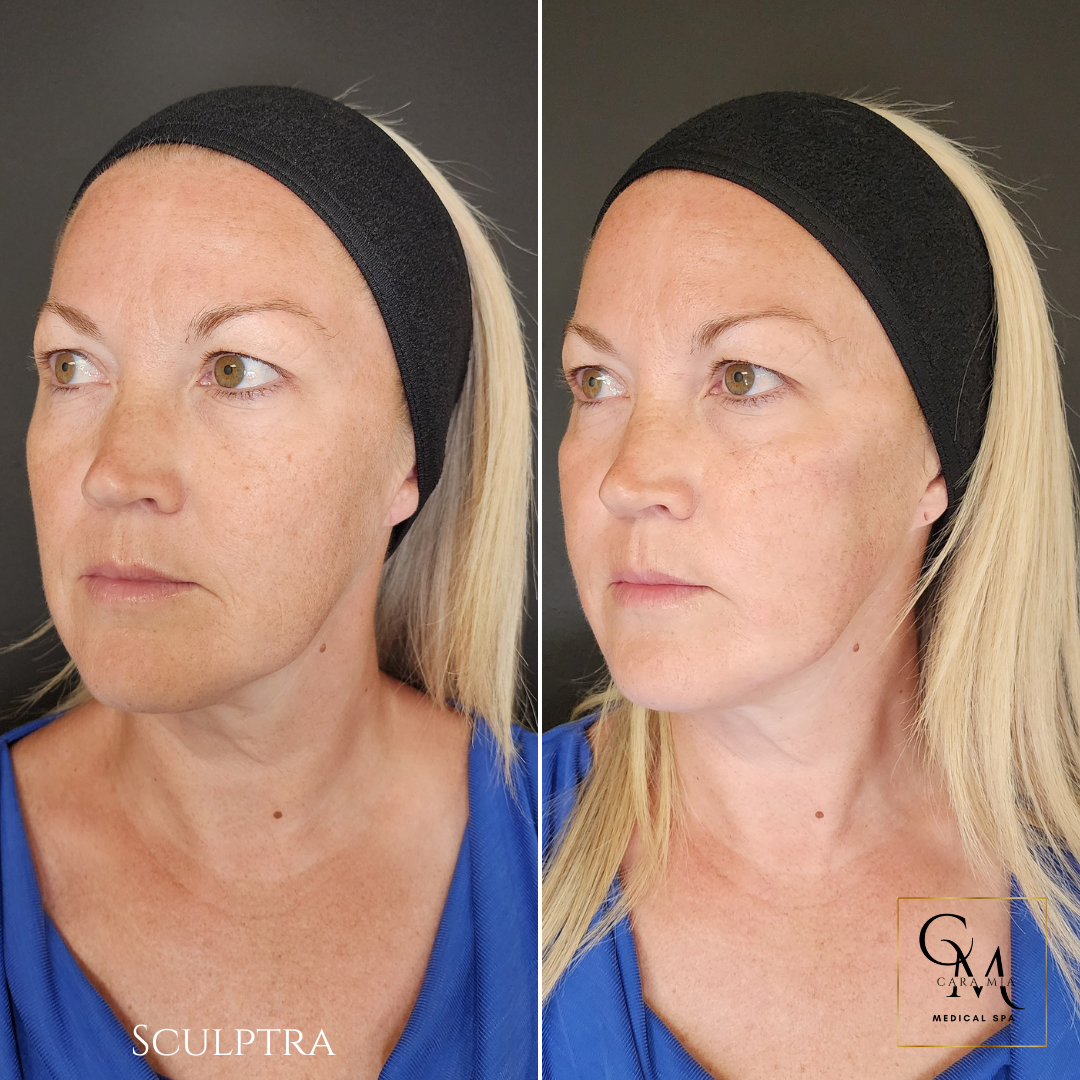 Before and after photos of woman with neck lift, showing skin tightening; black headband, blue shirt.