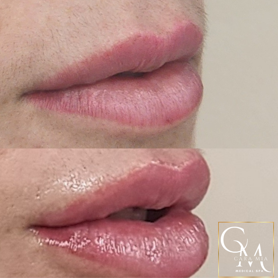 Comparison of lips before and after a lip enhancement procedure.